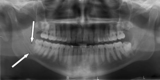 Panoramic Radiograph Showing The Two Mandibular Canals Open I