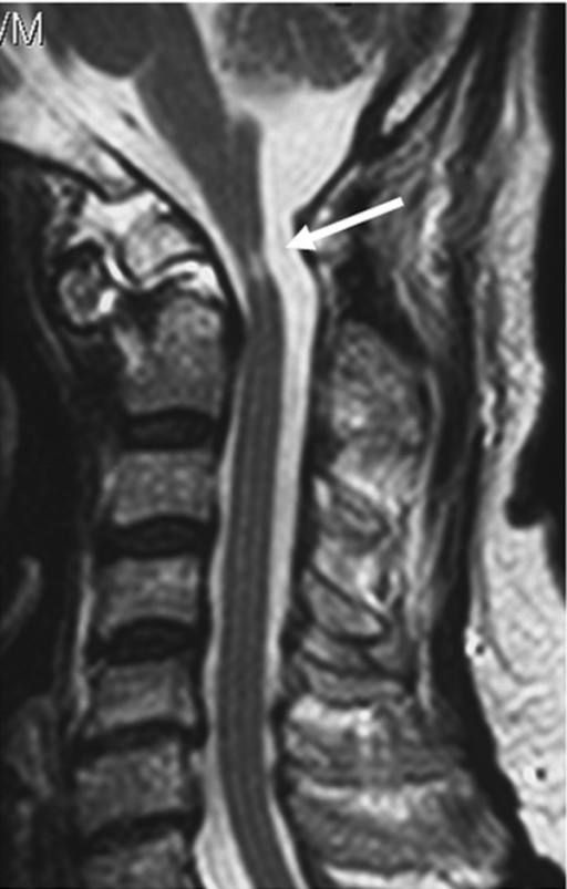 Preoperative Sagittal T2-weighted Magnetic Resonance Im | Open-i