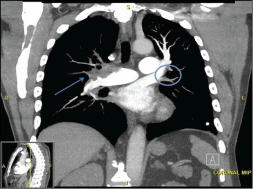 CT Pulmonary Angiogram Coronal View Maximum Intensity Open I