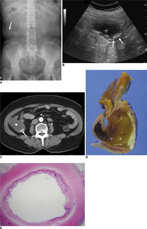 Mucinous Cystadenoma Of Appendix In 67 Year Old Man A Open I