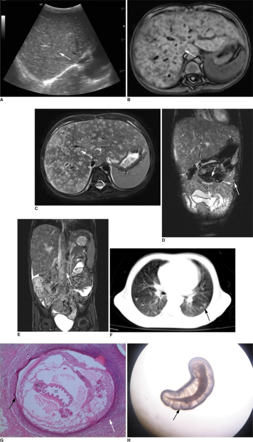 3-year-old girl with pentastomiasis infection, and she ...