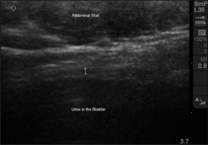 Trans Abdominal Ultrasound Image Of The Bladder At Open I