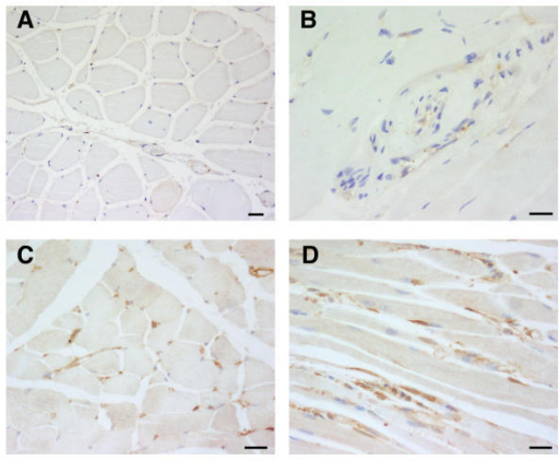 Invasive haemophilus influenzae disease in adults
