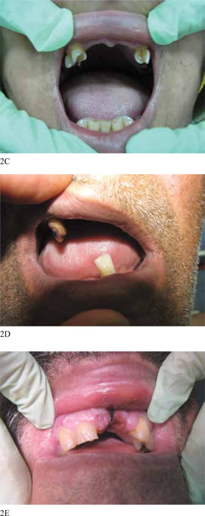 different-features-of-poor-dentition-in-patients-underg-open-i