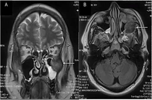 Coronal A And Axial B MRI Scans Demonstrating A Sof Open I