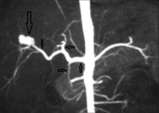 Coronal Plane Thick Multiplanar Reformation CT Angiogra Open I