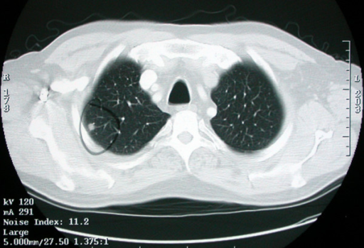 Chest CT Scan Showing A 1 Cm Right Upper Lobe Nodule Open I