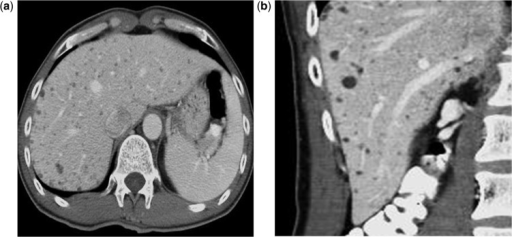 Multiple Bile Duct Hamartomas Axial A And Coronal B Open I