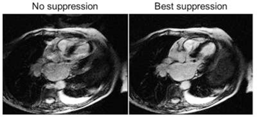 example-of-long-t1-ghosting-artifact-in-a-patient-with-open-i