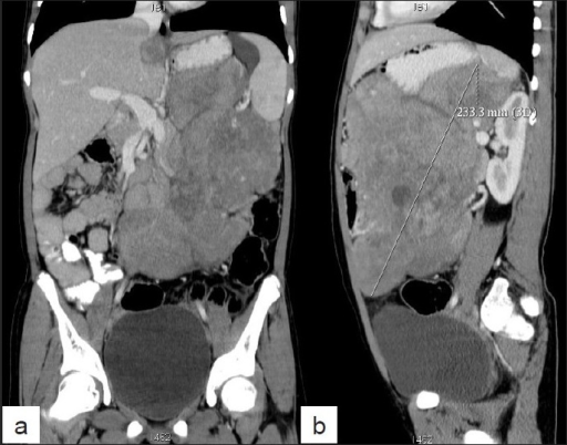 A B Coronal And Sagittal CT Scan Images Showing A L Open I