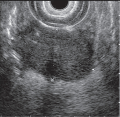 Endoscopic Ultrasound Of Duodenal Mass. 