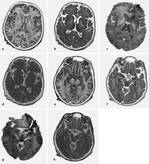 Typical Mr Imaging Features Of Wernickes Encephalopath Open I 1958