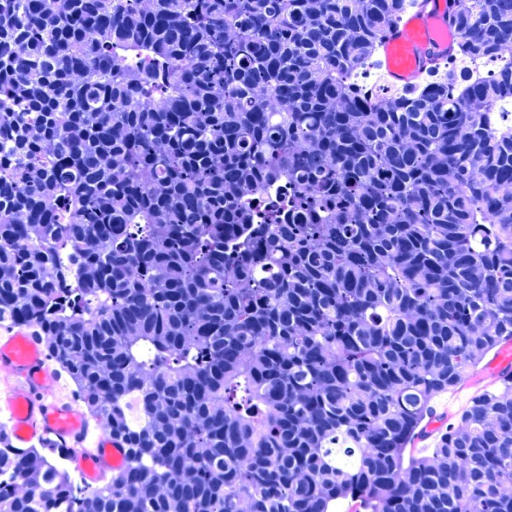 invasive-high-grade-transitional-cell-carcinoma-with-ne-open-i