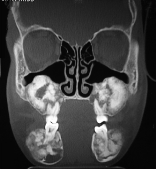 Coronal CT Scan Showing Extensive Mixed Radiopaque And Open I