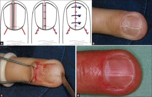 what-causes-toenails-to-crack-and-split-nails-dlystormgreek