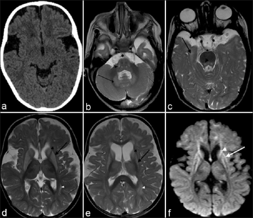 (a) Widened Sylvian Fissures On Ct Scan. (b-d) Mri Show 