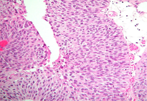 Low Grade Papillary Urothelial Carcinoma Open I 1367