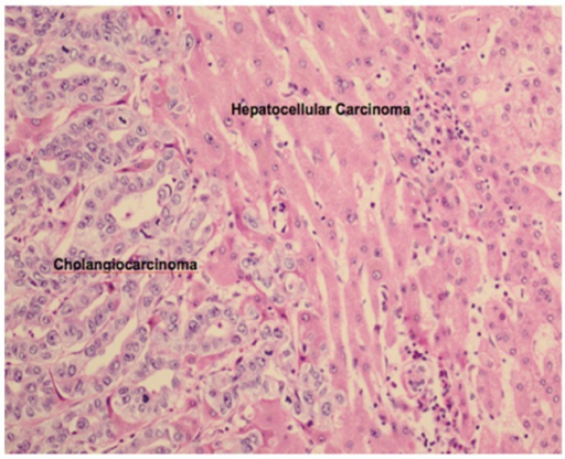 Pathology Of Combined Hepatocellular Carcinoma Cholangi Open I