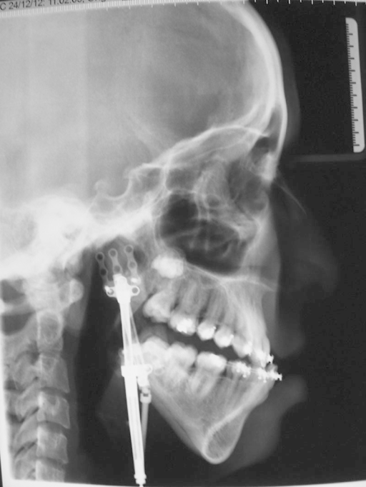 Bilateral Mandibular Distraction Osteogenesis And Defer Open I