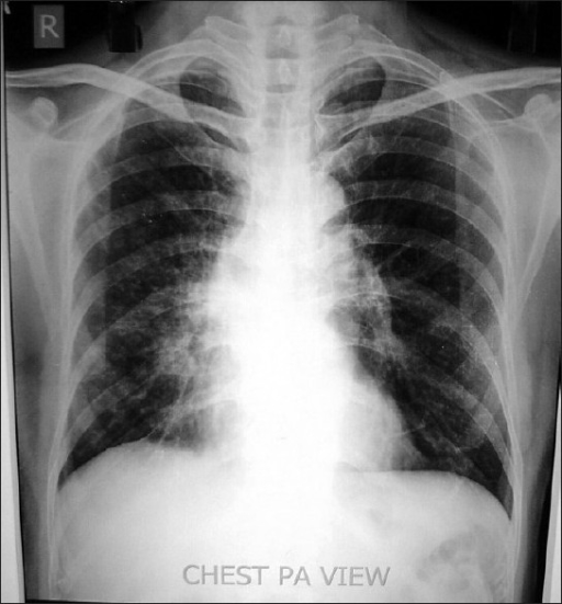 Chest X Ray Reveals Unfolding Of Aorta Hazy Right Para Open I