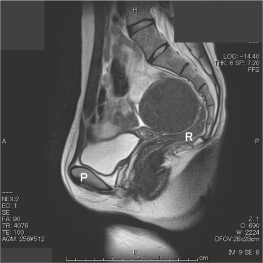 Pelvic Mri Images Are Shown Sagittal View Abbreviatio Open I