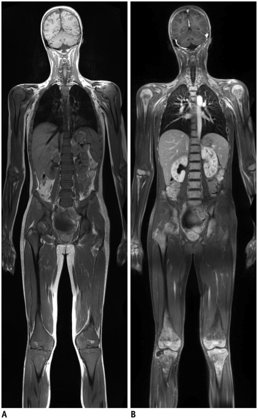 Year Old Boy With Leukemia A Coronal Pre Contrast T Open I