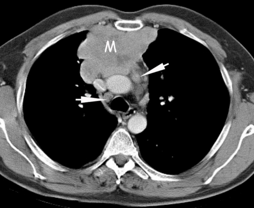 A Contrast Enhanced Ct Shows An Anterior Mediastinal Ma Open I