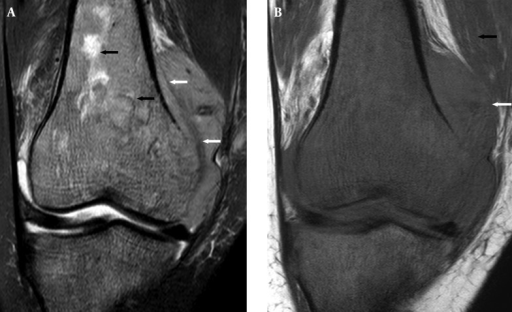 A Coronal T Weighted Fat Suppressed Mri Of The Knee Open I