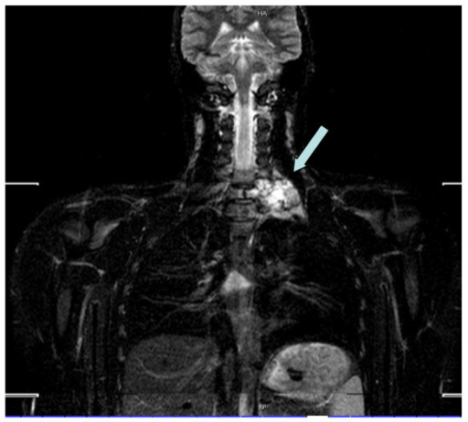 The Coronal Plane From The Mobi View Mri Scan Shows The Open I