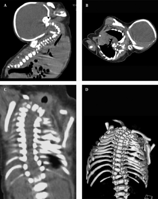 A Sagittal Reformatted MPR CT Image Of The Cervicothor Open I