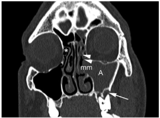 CT Scan Coronal Plane Corresponding To A 49 Years Old Open I