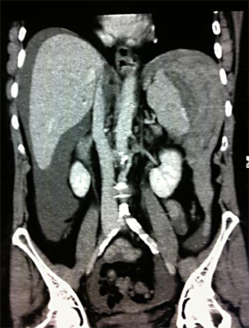Coronal Section Ct Scan Of The Abdomen Revealing Hemope Open I