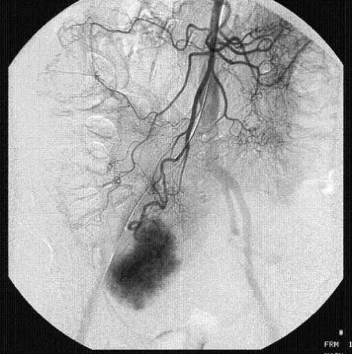 Selective Superior Mesenteric Artery Angiogram Showing Open I