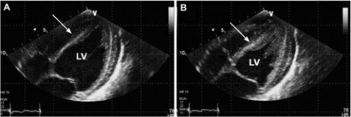 Follow-up transthoracic echocardiogram. A: the previous | Open-i
