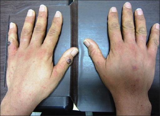 Orf Disease Erythema Multiforme As A Result Of Orf Dis Open I