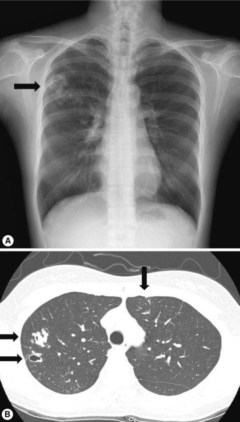 Follow Up Chest X Ray And CT A Interval Decreases In Open I