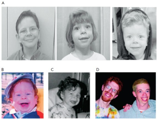 Facial characteristics of autism