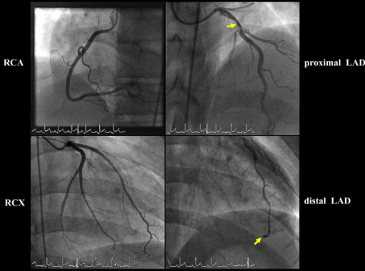 Invasive Coronary Angiography Demonstrates Single Vesse Open I