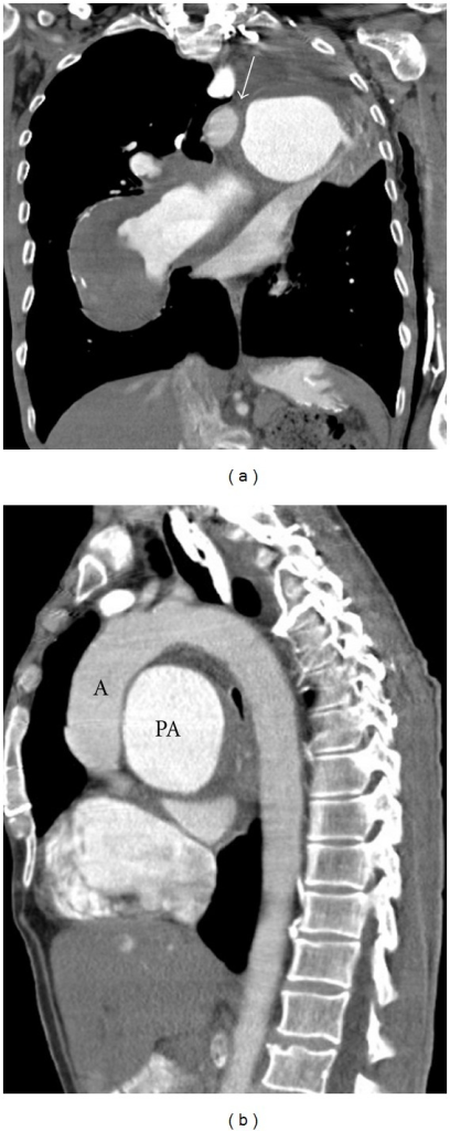 Coronal A And Sagittal Reformat B From The Ct The Open I