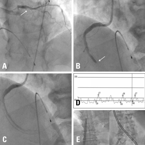 (A) Coronary Angiography Showed Total Occlusion In The | Open-i