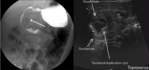 Duodenal Duplication Cyst A Frontal Fluoroscopic Pro Open I