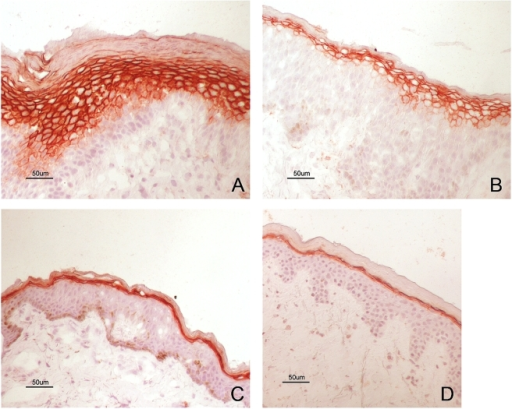 Increased TGM1 Protein Expression In AE Skin Immunohist Open I