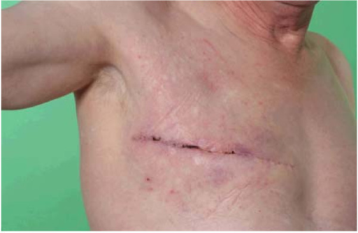pagets disease of the breast pictures 56398 pagets disease of the breast pictures 56397