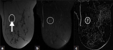 Intramammary Lymph Node Ultrasound