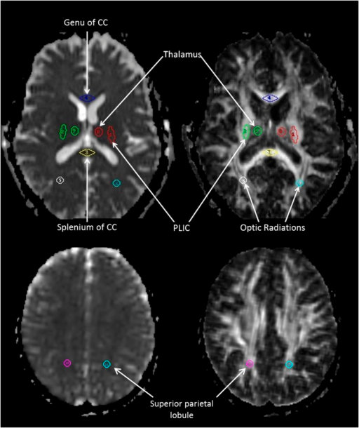 White Matter Lesions Defined By Diffusion Tensor Imaging In Older Adults White Matter Lesions Defined By Diffusion Tensor Imaging In Older Adults
