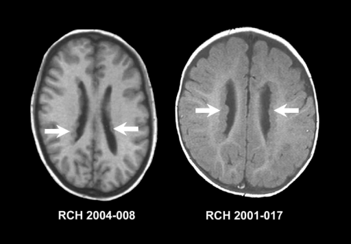 Imaging Features Of Periventricular Nodular Heterotopia Open I