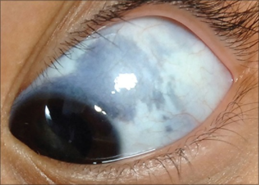 Ocular Melanocytosis Showing Episcleral Pigmentation Open I