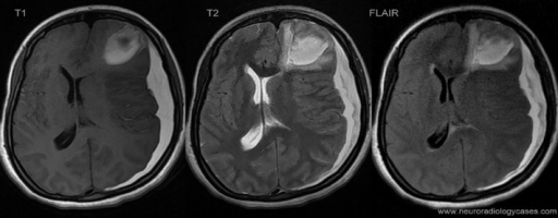 Epidural Hematoma T Mri