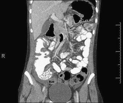 Coronal Reconstruction Of A Ct Scan Of The Abdomen And Open I