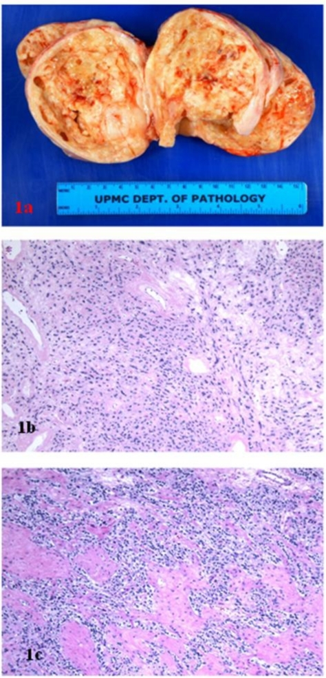 A Ovarian Stromal Tumor Gross Photograph B Sclerosi Open I 1192